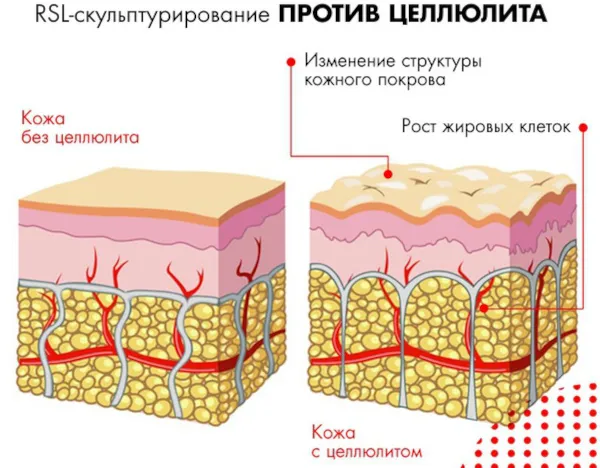 Как правильно проводить процедуру RSL-скульптурирование